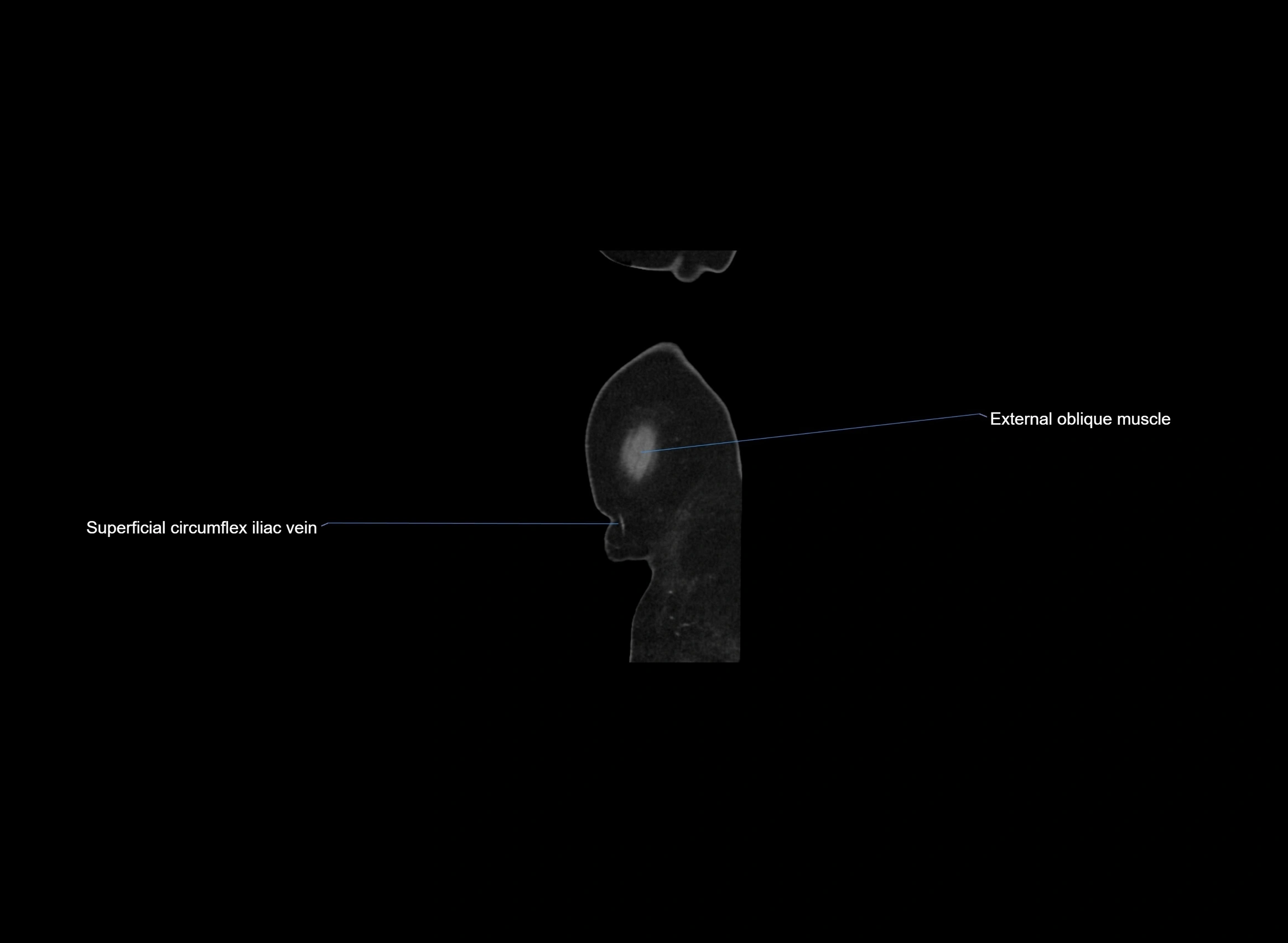 CT Abdomen sagittal cross sectional anatomy labelled radiology image -00002.webp